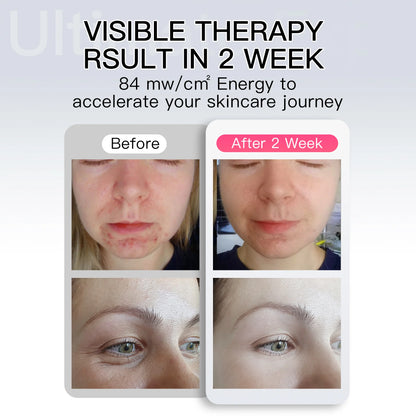 Before and after comparison of a person's skin with visible therapy results in 2 weeks.
